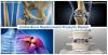 Photo for Bone Replacement Products Market : North America to Register a CAGR of 4.4%Between 2016 and 2024