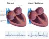 Photo for Atrial Fibrillation Market – Global Outlook, 2016–2024