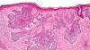 Photo for Actinic Keratosis Market – Global Trends, 2017–2025