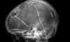 Photo for Deep Brain Stimulation Market Analysis by Product, by Test Location, by Technology, by Application and Segment Forecasts 2016- 2025