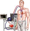 Photo for Extracorporeal Membrane Oxygenation Market - Global Industry Insights,  2025
