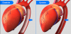 Photo for Global Intra-Aortic Balloon Pump (IABP) Market 2017 Forecast to 2022