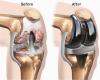 Photo for Knee Implants Market – Global Opportunity Analysis, 2017–2025
