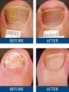 Photo for San Diego Laser Toe Fungus Removal Toe Nail Fungus Lasers