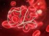 Photo for Asia-Pacific Thrombotic Thrombocytopenic Purpura Treatment Market Report 2018