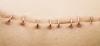 Photo for Surgical Staplers Market Was Valued At Us$ 2.8 Billion In 2017