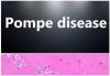 Photo for Pompe Disease Therapeutic Market - Global Industry Insights, Trends, Outlook and Analysis 2017 - 2025