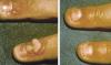 Photo for A Review of the 4 Most Popular Wart Removal Products