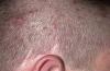 Photo for Hair Fungus Treatment