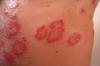 Photo for Plaque Psoriasis Treatment Market: Emerging Market Trends, Size, Share and Growth Analysis 2025