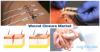 Photo for Wound Closure Market to Surpass US$ 2.3 Billion by 2025 with CAGR of 7.1%