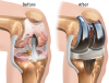 Photo for Global Joint Replacement Market Forecast to 2023