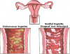 Photo for Global Drugs for Vulvovaginal Candidiasis Market Forecast to 2023