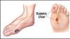 Photo for Diabetic Foot Ulcers Treatment Market - Global Trends and Forecast to 2025