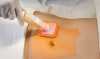 Photo for Global Chlorhexidine Gluconate (CHG) Solution Market Forecast to 2023