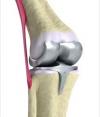 Photo for Asia-Pacific Knee Implants Market Report 2018