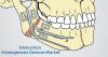 Photo for Distraction Osteogenesis Devices Market - Global Industry Insights, Trends, and  Analysis, 2017-2025