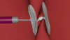 Photo for Global PFO Closure Device Market Forecast to 2023