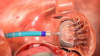 Photo for Global Atrial Fibrillation Devices Market Forecast to 2023