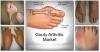 Photo for Gouty Arthritis Market - Global Industry Insights and Opportunity Analysis 2025