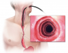 Photo for Global Eosinophilic Esophagitis Drug Market Forecast to 2023