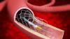 Photo for Angioplasty Balloons Market-Outlook,2018