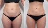 Photo for Body Contouring Surgery in Delhi