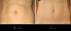 Photo for Tummy Tuck Surgery in Delhi