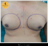 Photo for Gynecomastia Surgery in Delhi
