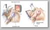Photo for Breast Reduction surgery in delhi