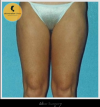 Photo for Best liposuction surgery in delhi