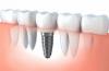 Photo for Best dental implant specialist Kingfisher - Kingfisher Dental
