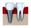 Photo for Comprehensive study explores how Testing, Inspection, And Certification TIC For Titanium Dental Implants market will grow in Future