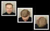 Photo for hair transplant