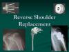 Photo for shoulder replacement surgeon in delhi