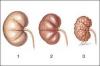Photo for Ayurvedic Treatment for Kidney Failure Disorder