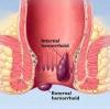 Photo for Ayurvedic treatment for Piles in delhi