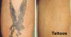 Photo for Tattoo Removal treatment in Delhi