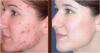 Photo for Laser Acne Scar Removal in Delhi