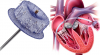 Photo for Global Atrial Fibrillation Devices Market 2018 Forecast to 2023
