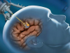 Photo for Global Ablation Technologies Market Forecast to 2023
