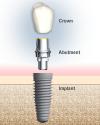 Photo for Osseointegration Implants Market-Report Highlights the Competitive Scenario with Impact of Drivers and Challenges