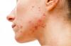 Photo for Acne Vulgaris Treatment Market  – Global Outlook, and Trends 2025