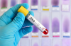 Photo for Global Zika Virus Testing Market 2018 Forecast to 2023