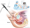 Photo for Global Cystoscope Market 2018 Forecast to 2023
