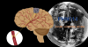 Photo for Acute Ischemic Stroke Diagnosis and Treatment Market Outlook: Highlights the competitive scenario of the market, major competitors, and benchmarking