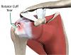 Photo for Rotator Cuff Jacksonville