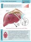 Photo for Global Tumor Ablation Market Production, Consumption And Quality Overview 2017 To 2024