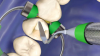 Photo for Global Indirect Restorative Materials of Dental Consumables Market 2018 Forecast to 2023