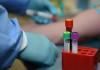 Photo for Coagulation Testing Market Segmentation and Analysis by Recent Trends and Growth by Regions to 2023